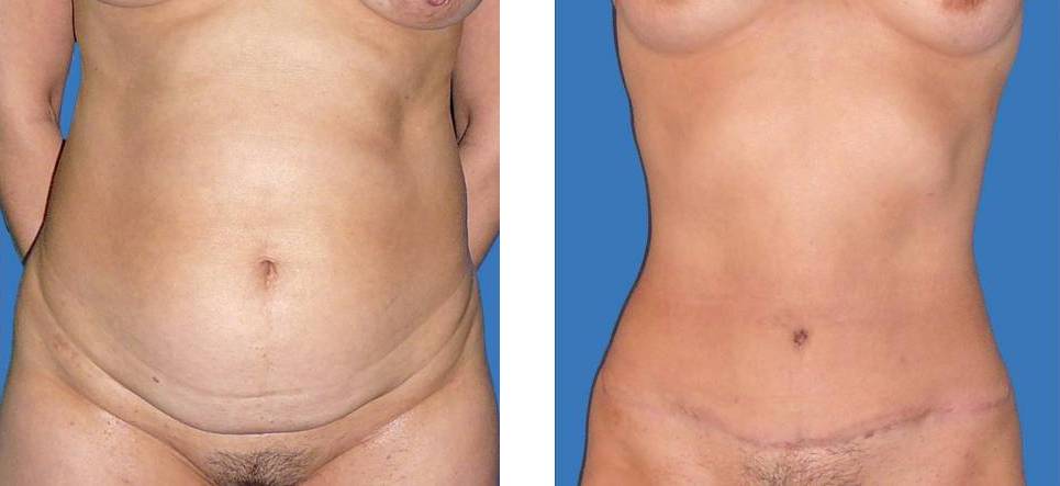 abdominoplastia_Lipectomia_dr_cabello_frente
