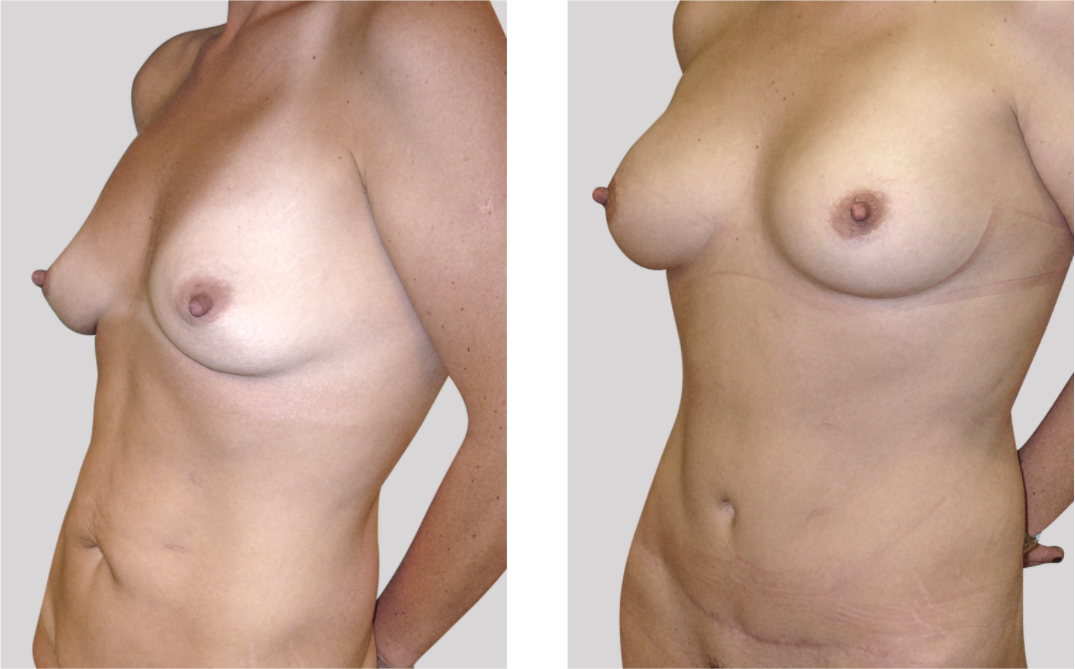 Abdominoplastia_+_ mamas_dr_cabello_perfil