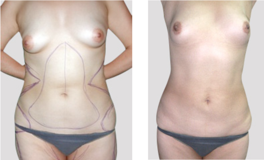 antes_despues_rinoplastia_dr_cabello