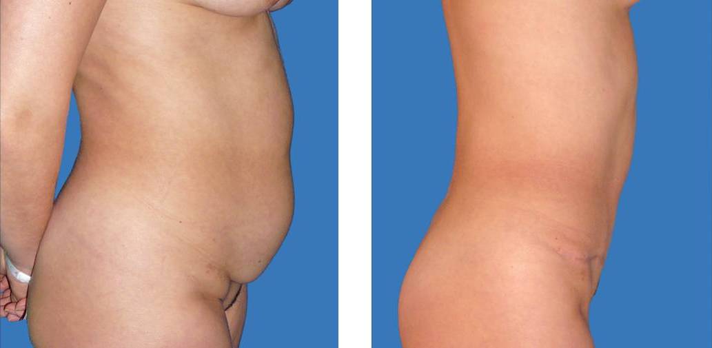 abdominoplastia_Lipectomia_dr_cabello_costado