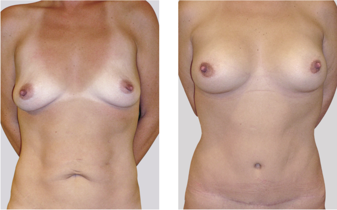 Abdominoplastia_+_ mamas_dr_cabello_frentee