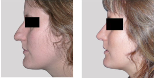 antes_despues_rinoplastia_dr_cabello