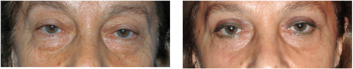antes_despues_rinoplastia_dr_cabello
