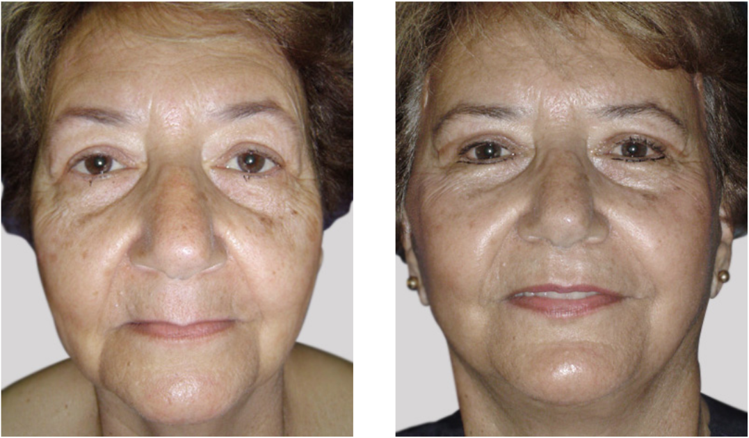 antes_despues_rinoplastia_dr_cabello