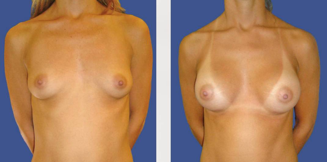 antes_despues_rinoplastia_dr_cabello