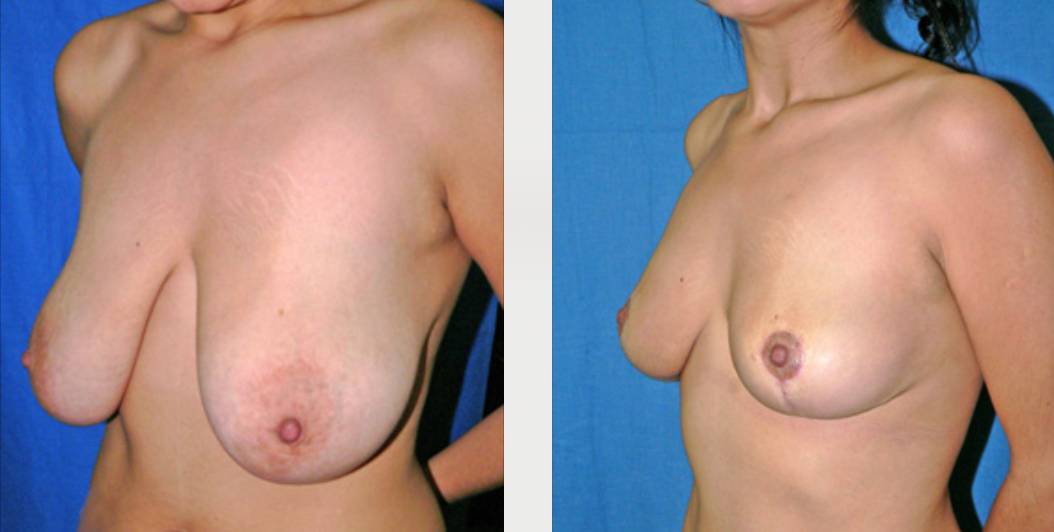 antes_despues_rinoplastia_dr_cabello