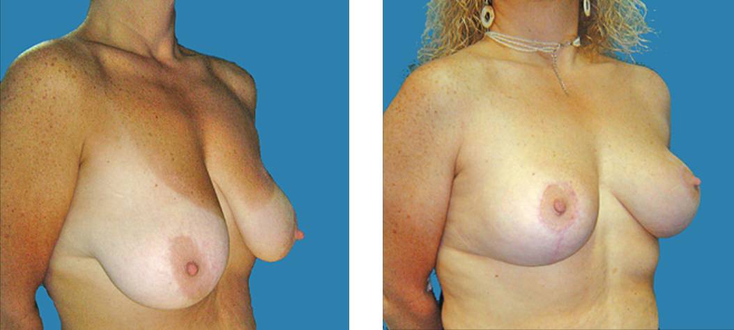 Mastopexia_levantamiento_pechos_dr_cabello