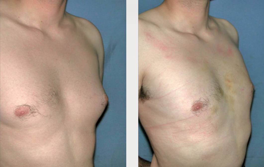 antes_despues_rinoplastia_dr_cabello