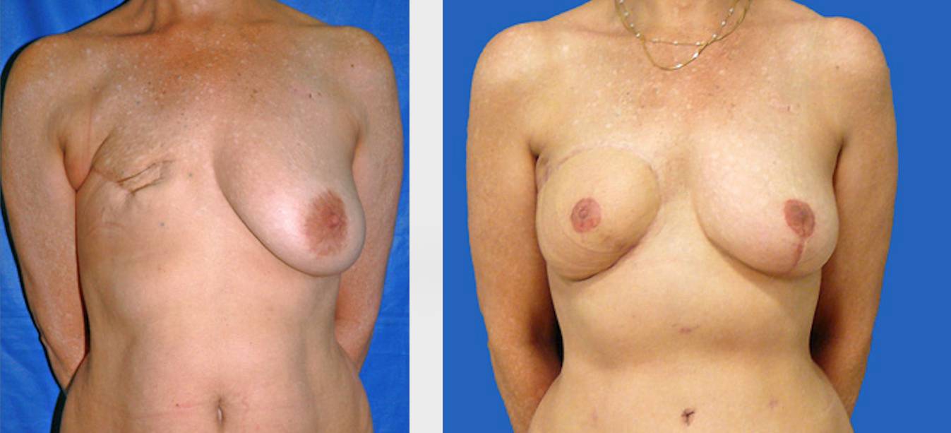 antes_despues_rinoplastia_dr_cabello