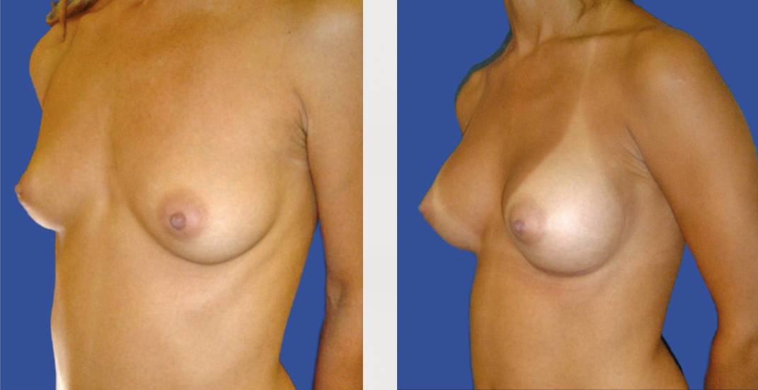 antes_despues_rinoplastia_dr_cabello