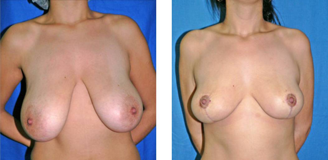 antes_despues_rinoplastia_dr_cabello