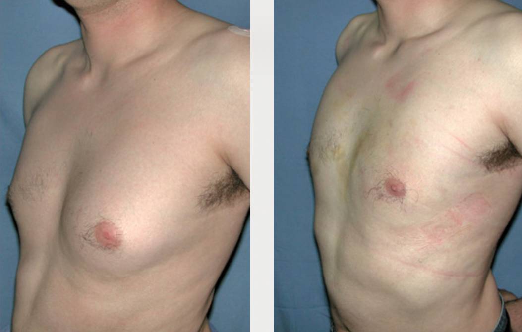antes_despues_rinoplastia_dr_cabello