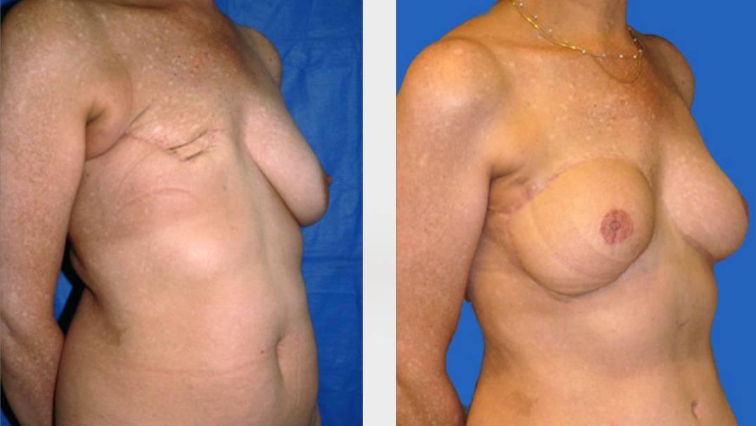 antes_despues_rinoplastia_dr_cabello
